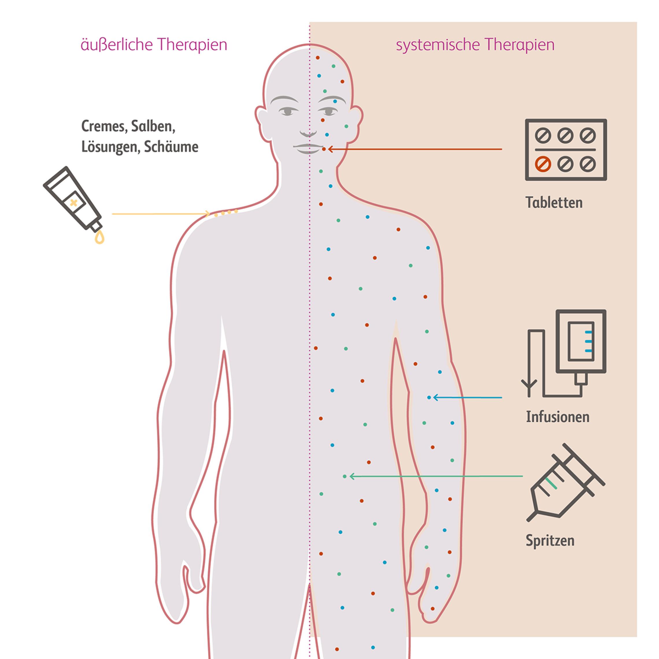 Zur Behandlung von Psoriasis stehen Topika, Lichttherapien und systemische Therapien zur Verfügung.