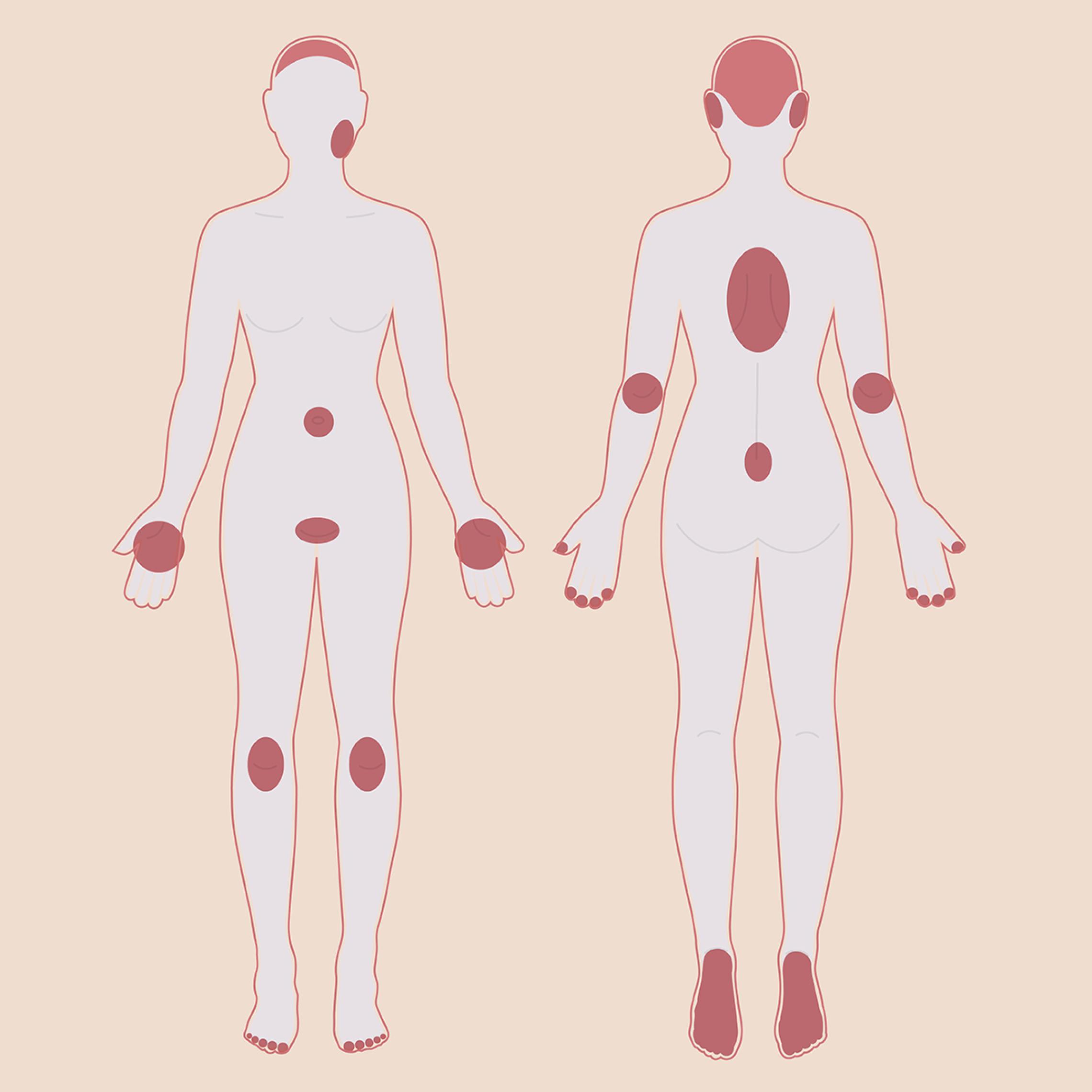 Psoriasis kann an verschiedenen Körperstellen auftreten. Oft betroffen sind Kopfhaut, Arme und Beine. 