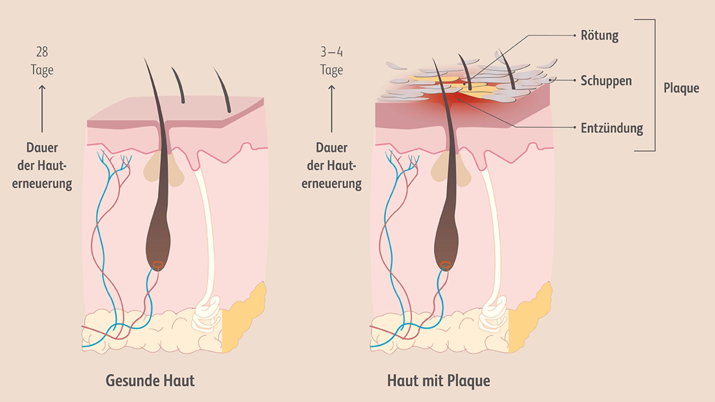 Ein für Psoriasis typischer Plaque, also eine verdickte, gerötete, entzündete, schuppige, meist scharf begrenzte, oft juckende Hautstelle im Vergleich zur gesunden Haut.