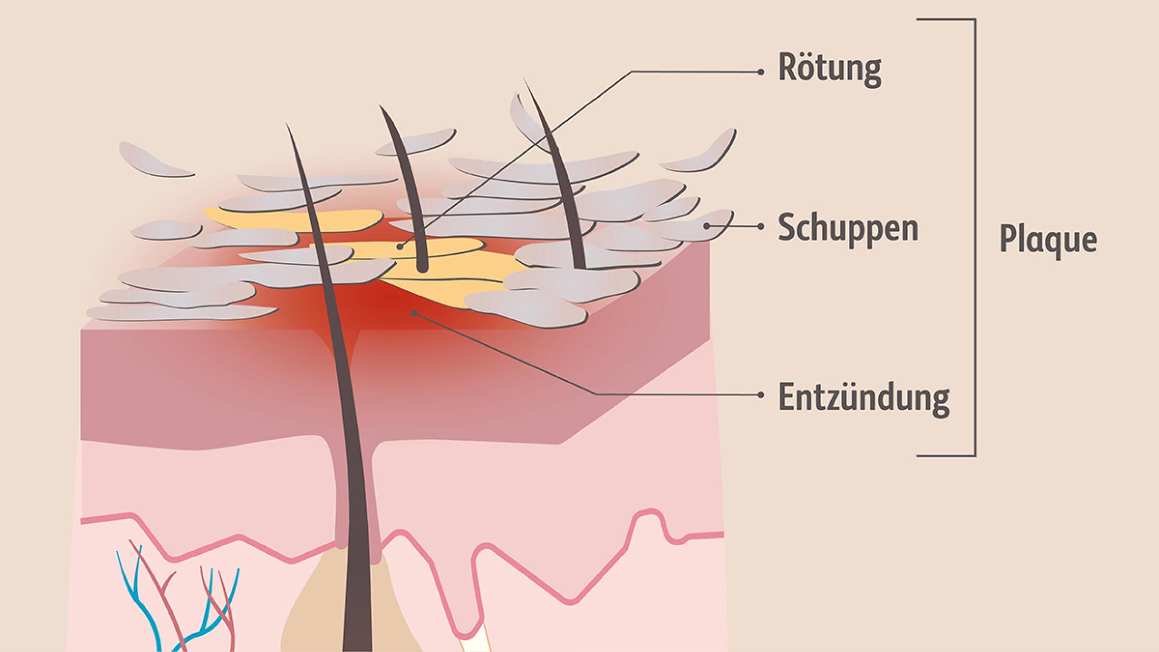 Ein für Psoriasis typischer Plaque, also eine verdickte, gerötete, entzündete, schuppige, meist scharf begrenzte, oft juckende Hautstelle.